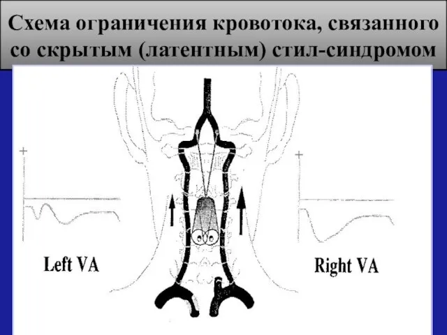 Схема ограничения кровотока, связанного со скрытым (латентным) стил-синдромом обкрадывания + +