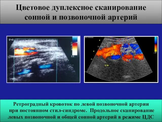 Ретроградный кровоток по левой позвоночной артерии при постоянном стил-синдроме. Продольное сканирование