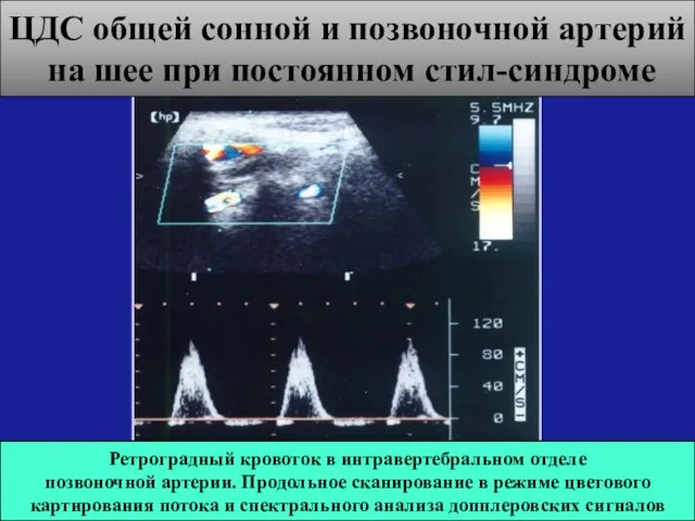 ЦДС общей сонной и позвоночной артерий на шее при постоянном стил-синдроме