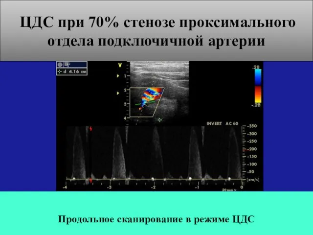 Продольное сканирование в режиме ЦДС ЦДС при 70% стенозе проксимального отдела подключичной артерии