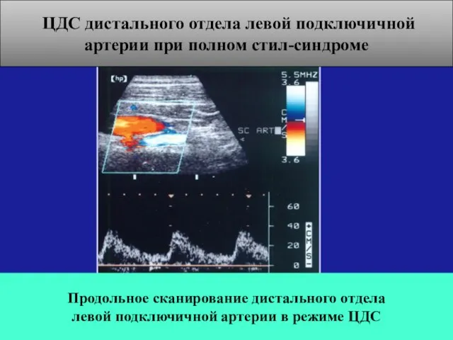 Продольное сканирование дистального отдела левой подключичной артерии в режиме ЦДС ЦДС