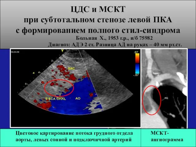 ЦДС и МСКТ при субтотальном стенозе левой ПКА с формированием полного