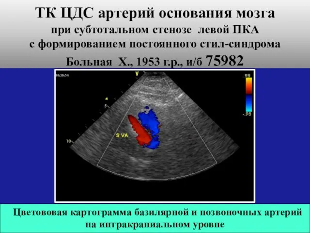 ТК ЦДС артерий основания мозга при субтотальном стенозе левой ПКА с