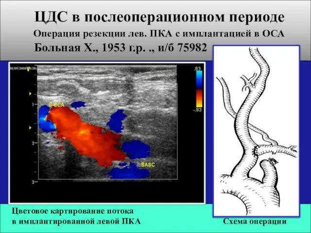 Цветовое картирование потока в имплантированной левой ПКА Схема операции ЦДС в