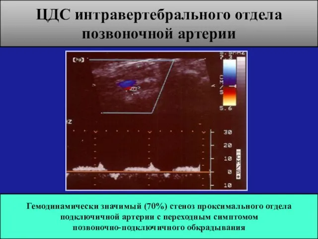 Гемодинамически значимый (70%) стеноз проксимального отдела подключичной артерии с переходным симптомом
