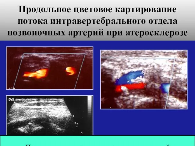 Продольное цветовое картирование потока интравертебрального отдела позвоночных артерий при атеросклерозе Продольное