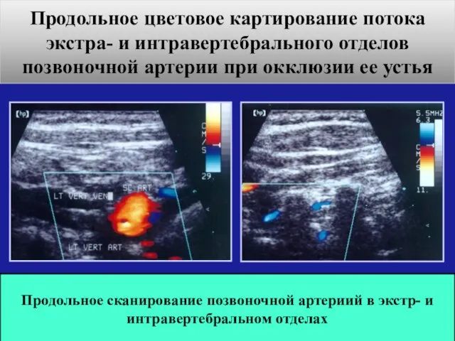 Продольное цветовое картирование потока экстра- и интравертебрального отделов позвоночной артерии при