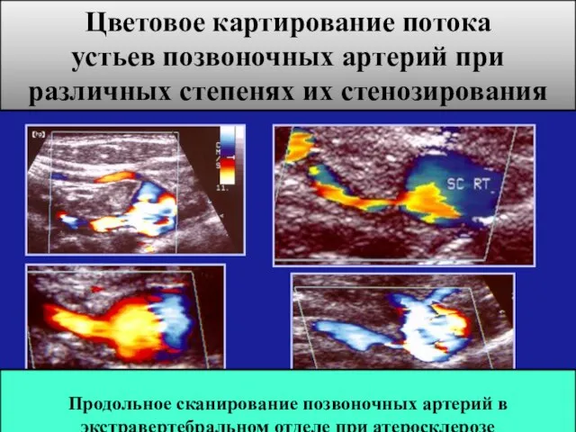 Цветовое картирование потока устьев позвоночных артерий при различных степенях их стенозирования