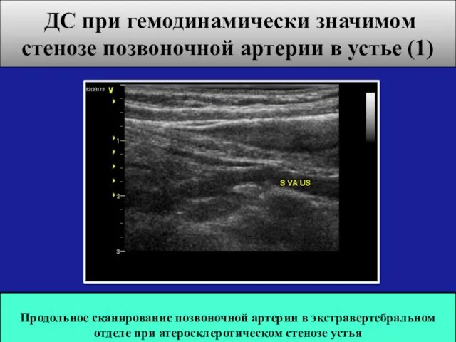 ДС при гемодинамически значимом стенозе позвоночной артерии в устье (1) Продольное