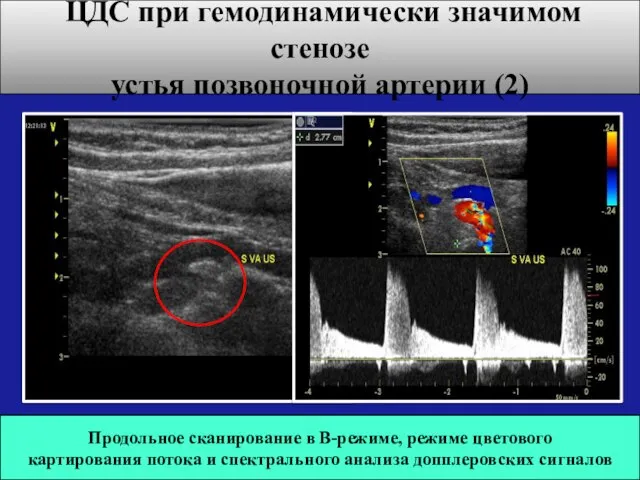 Продольное сканирование в В-режиме, режиме цветового картирования потока и спектрального анализа