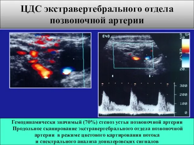 Гемодинамически значимый (70%) стеноз устья позвоночной артерии Продольное сканирование экстравертебрального отдела