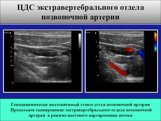 Гемодинамически малозначимый стеноз устья позвоночной артерии Продольное сканирование экстравертебрального отдела позвоночной