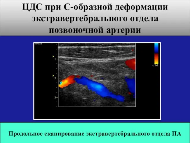 ЦДС при С-образной деформации экстравертебрального отдела позвоночной артерии Продольное сканирование экстравертебрального отдела ПА