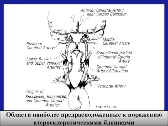 Области наиболее предрасположенные к поражению атеросклеротическими бляшками