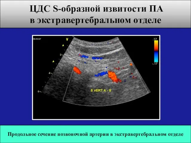 Продольное сечение позвоночной артерии в экстравертебральном отделе ЦДС S-образной извитости ПА в экстравертебральном отделе