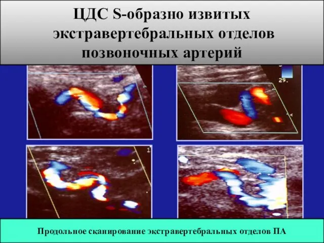 Продольное сканирование экстравертебральных отделов ПА ЦДС S-образно извитых экстравертебральных отделов позвоночных артерий