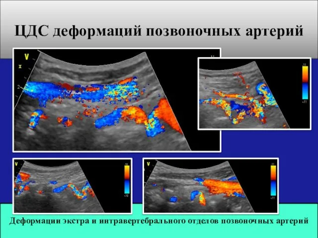 ЦДС деформаций позвоночных артерий Деформации экстра и интравертебрального отделов позвоночных артерий