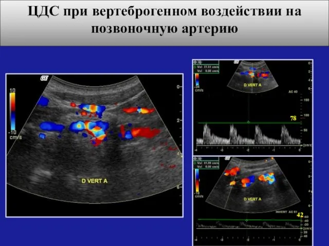 ЦДС при вертеброгенном воздействии на позвоночную артерию Гемодинамически значимая деформация позвоночной