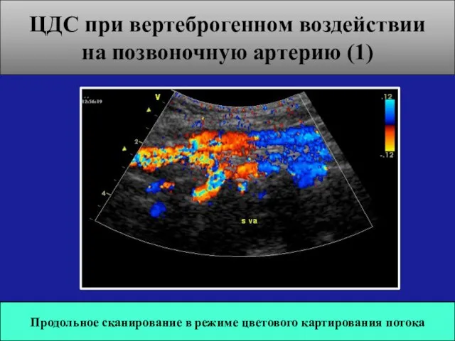 ЦДС при вертеброгенном воздействии на позвоночную артерию (1) Продольное сканирование в режиме цветового картирования потока