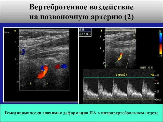 Вертеброгенное воздействие на позвоночную артерию (2) Гемодинамически значимая деформация ПА в интравертебральном отделе 58