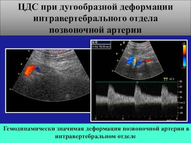 ЦДС при дугообразной деформации интравертебрального отдела позвоночной артерии Гемодинамически значимая деформация