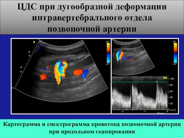 ЦДС при дугообразной деформации интравертебрального отдела позвоночной артерии Картограмма и спектрограмма