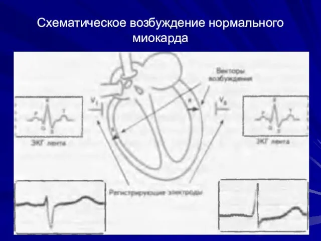 Схематическое возбуждение нормального миокарда