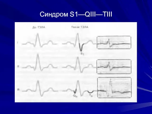 Синдром S1—QIII—ТIII