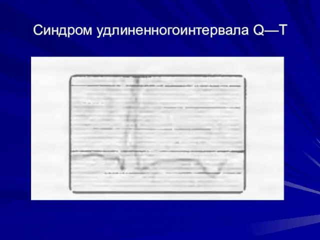 Синдром удлиненногоинтервала Q—Т