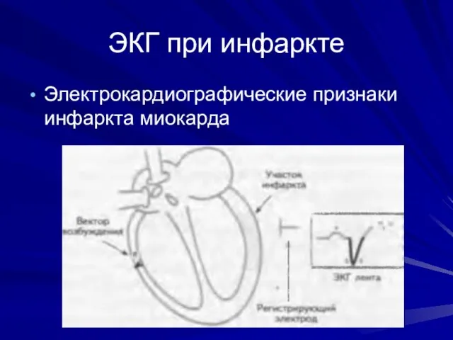 ЭКГ при инфаркте Электрокардиографические признаки инфаркта миокарда