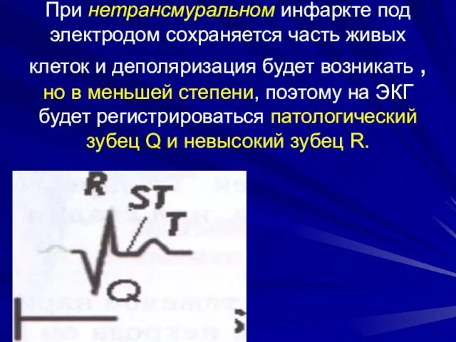 При нетрансмуральном инфаркте под электродом сохраняется часть живых клеток и деполяризация