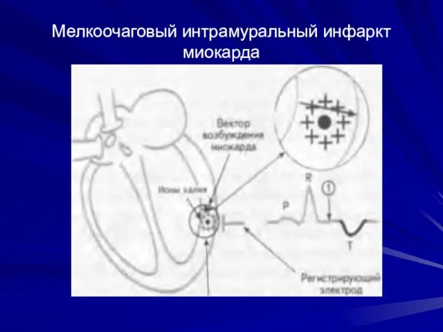 Мелкоочаговый интрамуральный инфаркт миокарда