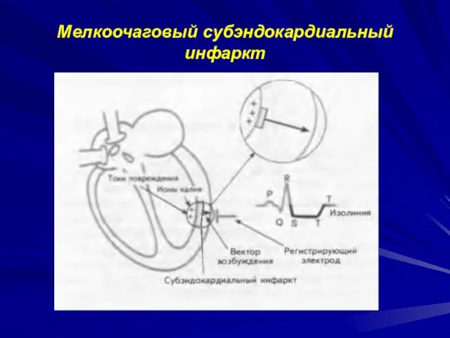 Мелкоочаговый субэндокардиальный инфаркт