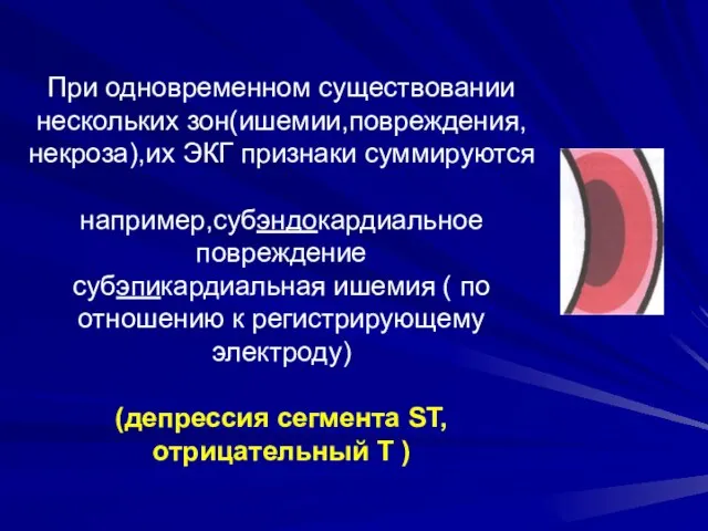 При одновременном существовании нескольких зон(ишемии,повреждения,некроза),их ЭКГ признаки суммируются например,субэндокардиальное повреждение субэпикардиальная