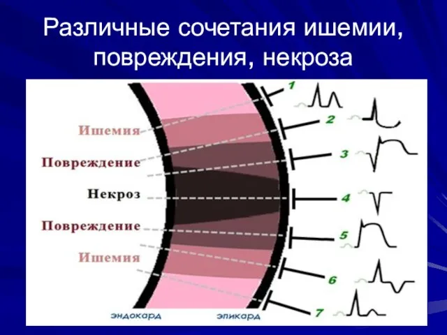 Различные сочетания ишемии, повреждения, некроза