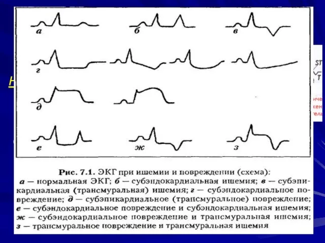 Нетрансмуральный инфаркт миокарда ,субэпикардиальная ишемия – патологический Q ,снижен R, отрицательный
