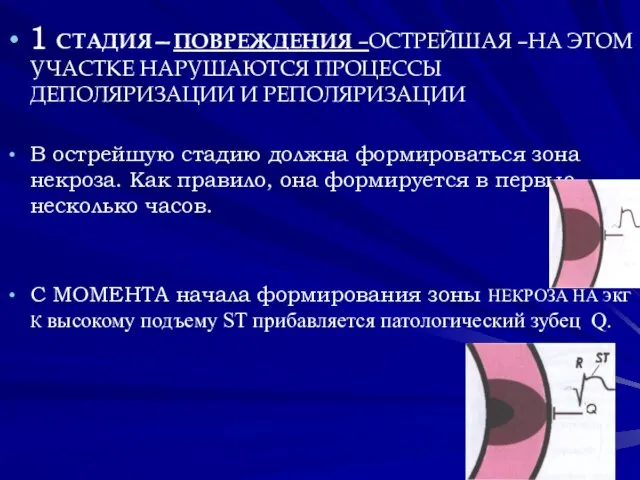 1 СТАДИЯ—ПОВРЕЖДЕНИЯ –ОСТРЕЙШАЯ –НА ЭТОМ УЧАСТКЕ НАРУШАЮТСЯ ПРОЦЕССЫ ДЕПОЛЯРИЗАЦИИ И РЕПОЛЯРИЗАЦИИ