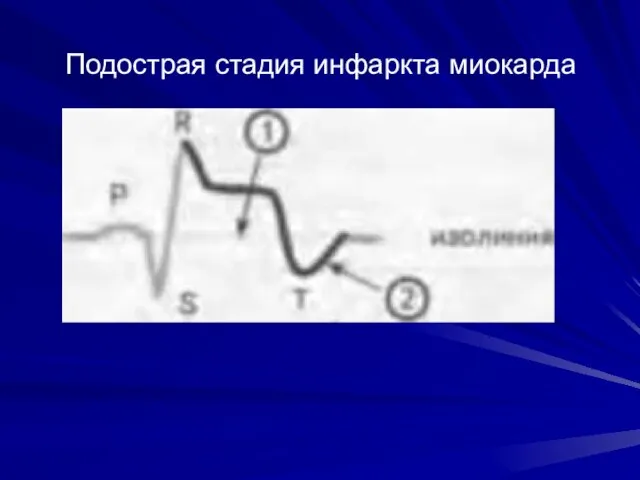 Подострая стадия инфаркта миокарда