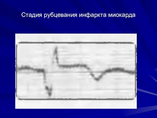 Стадия рубцевания инфаркта миокарда