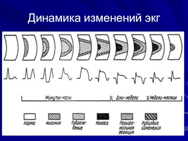 Динамика изменений экг