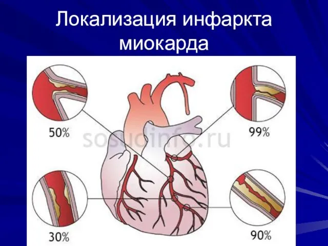 Локализация инфаркта миокарда
