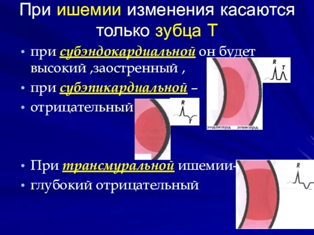 При ишемии изменения касаются только зубца Т при субэндокардиальной он будет