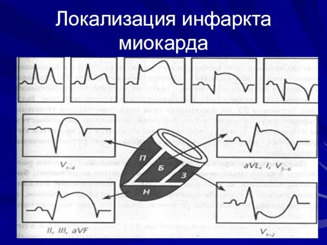 Локализация инфаркта миокарда