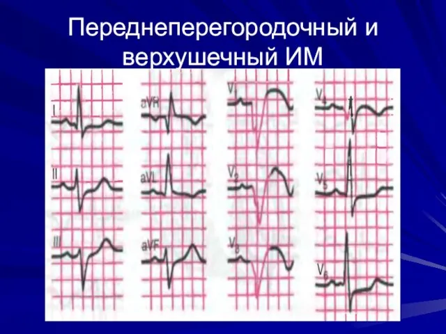 Переднеперегородочный и верхушечный ИМ