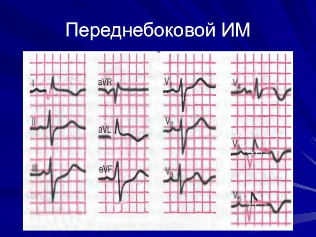 Переднебоковой ИМ