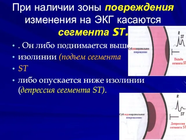 При наличии зоны повреждения изменения на ЭКГ касаются сегмента SТ. .