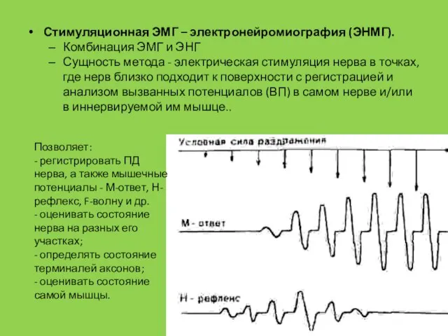 Стимуляционная ЭМГ – электронейромиография (ЭНМГ). Комбинация ЭМГ и ЭНГ Сущность метода