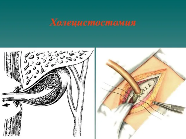 Холецистостомия