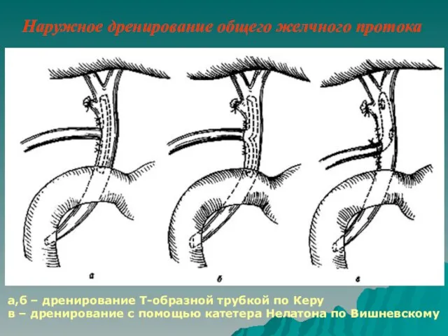 Наружное дренирование общего желчного протока а,б – дренирование T-образной трубкой по