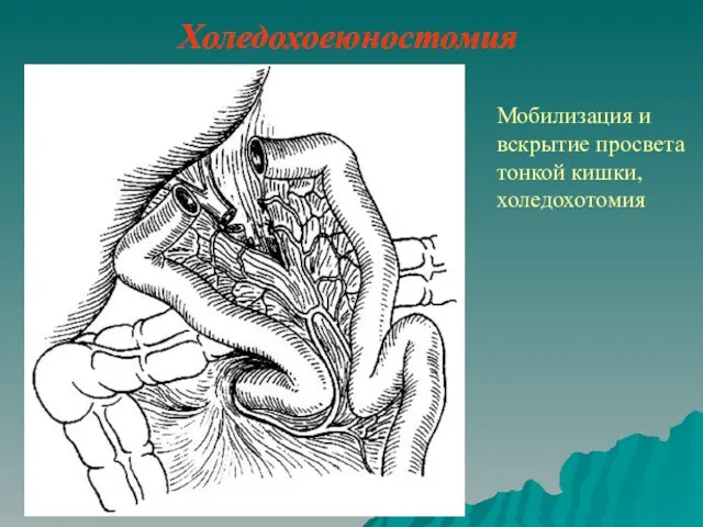 Холедохоеюностомия Мобилизация и вскрытие просвета тонкой кишки, холедохотомия